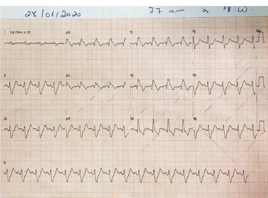 Hombre de 79 años fumador e HTA que presenta ángor intenso de inicio actual por SCA por compromiso de TCI que pressenta circulación colateral desde la CD