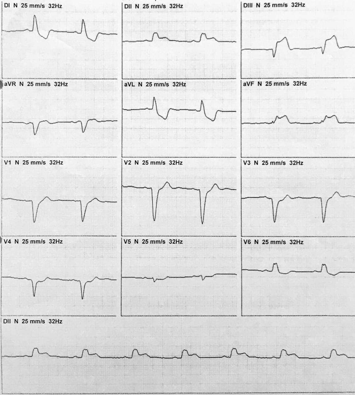 Paciente de 55 años con antecedentes de enfermedad coronaria difusa rechazado de cirugía que presenta episodio de ángor prolongado y disnea sometido a trombolisis con signos de reperfusión de CD