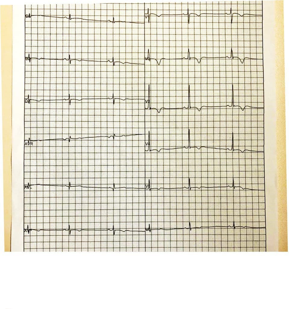Hombre joven del que se carece de datos clínicos que en ECG de rutina presenta alteraciones en la repolarización que motivan realizarle RNM en la que se constatan signos de displasia arritmogénica del VD con compromiso del VI