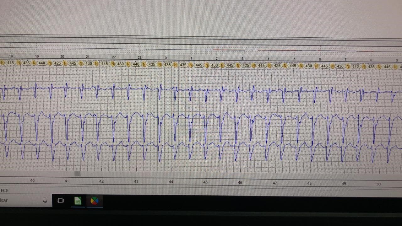 Holter de paciente masculino de 42 años con palpitaciones que presenta taquicardia incesante correspondiente a TV fascicular