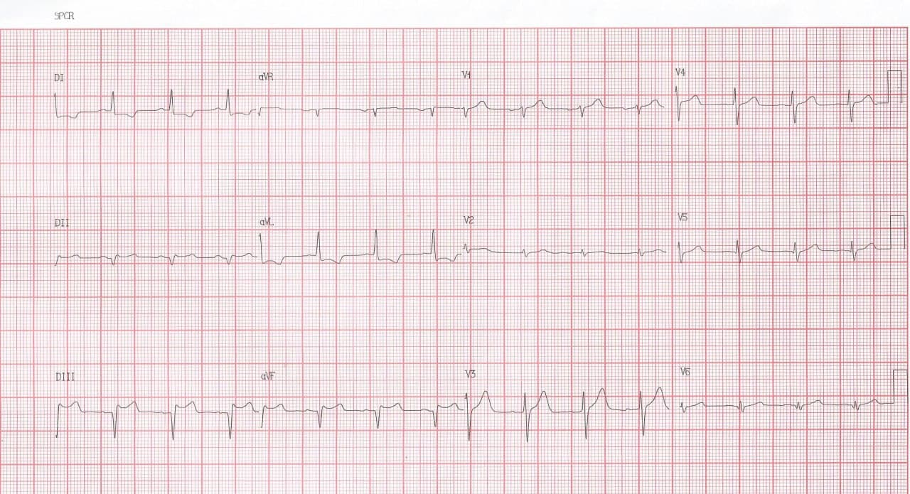 Hombre de 43 años con episodio de ángor prolongado que presenta enfermedad coronaria difusa con compromiso de TCI quién es derivado a cirugía de revascularización