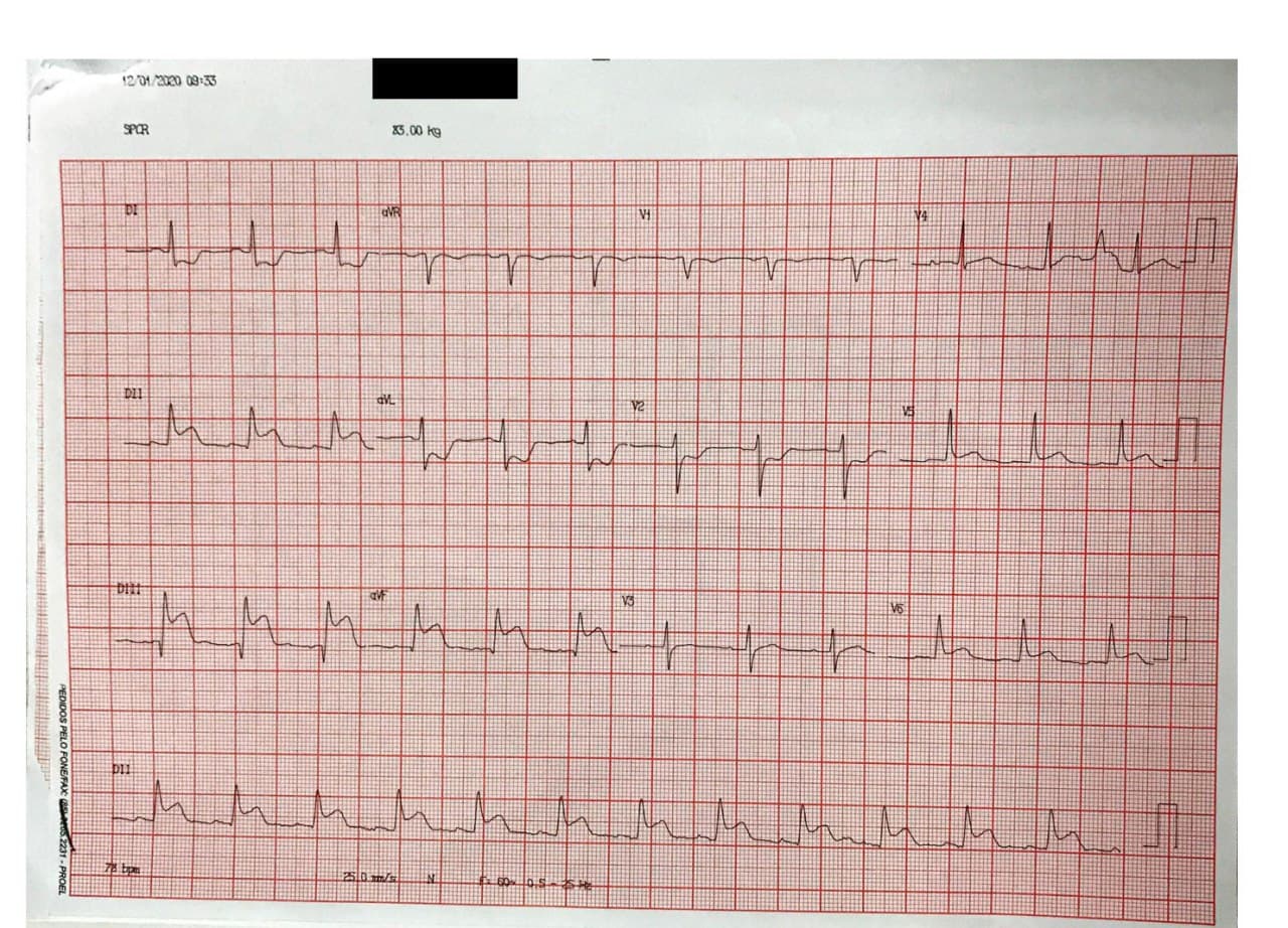 Paciente cursando SCA con presencia de signo de Kussmaul en cuello indicativo de compromiso de VD por severa enfermedad de CD