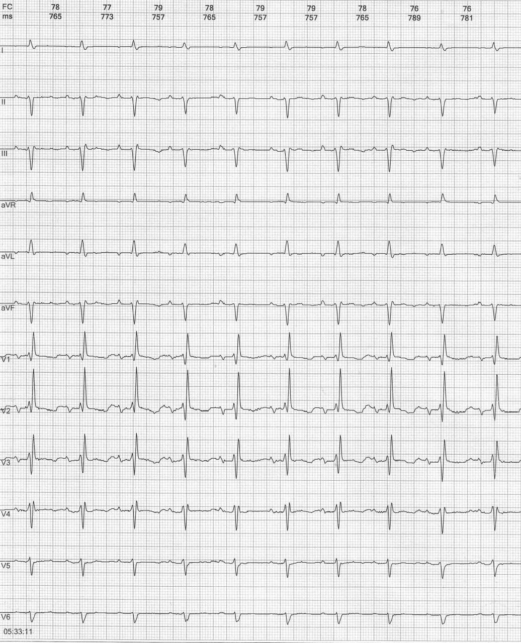 Mujer de 81 años que presenta episodio sincopal debido a presencia de bloqueo bifascicular que evoluciona a BAV 2:1 y posterior torsade de pointe por QTL