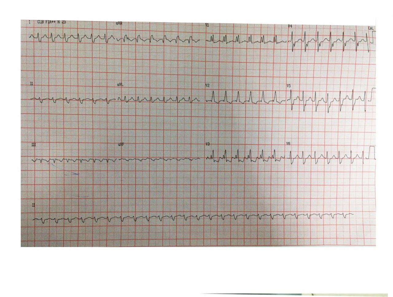 Hombre de 70 años que presenta taquicardia auricular focal originada en atrio izquierdo y su respuesta a la adenosina
