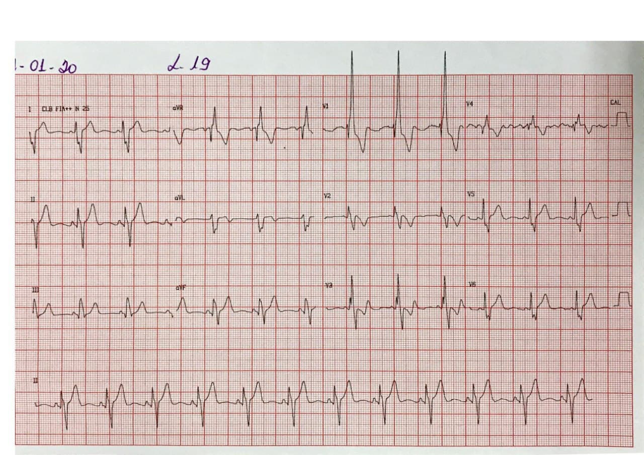 Varón de 18 años portador de tetralogía de Fallot corregida a los 7 años que presenta signos de CVD