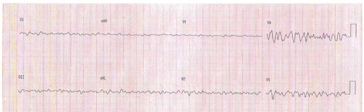 Paciente masculino de 25 años con antecedentes de «arritmias en la infancia» que ingresa con cuadro de FV post libación alcohólica requiriendo CVE y restauración de actividad cardíaca con presencia de FA preexcitada por vía accesoria