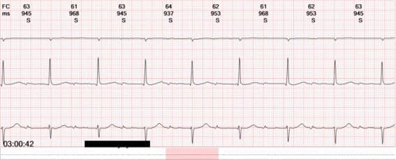 Mujer mayor con palpitaciones nocturnas con presentación electrocardiográfica poco habitual de una TRIN 2:1 confirmada en EEF con ablación posterior exitosa