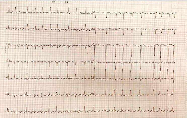 Hombre de 58 años hipertenso y fumador con disnea progresiva que presenta aleteo auricular con BAV variable atribuible a compromiso de la arteria DA