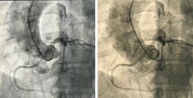 Mujer de 56 años, obesa, dislipémica y tabaquista con ángor de reciente comienzo, PEG + por ángor y ST que presenta nacimiento anómalo de CD