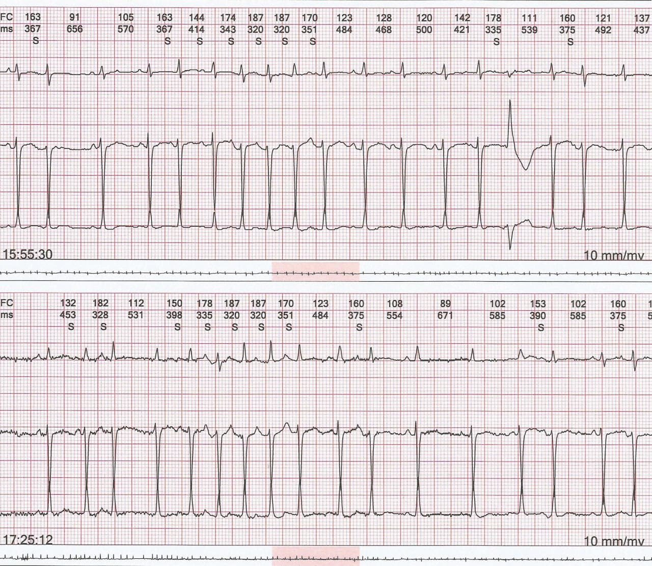 Mujer hipertensa de 94 años cursando broncopatía descompensada que presenta taquicardia auricular multifocal
