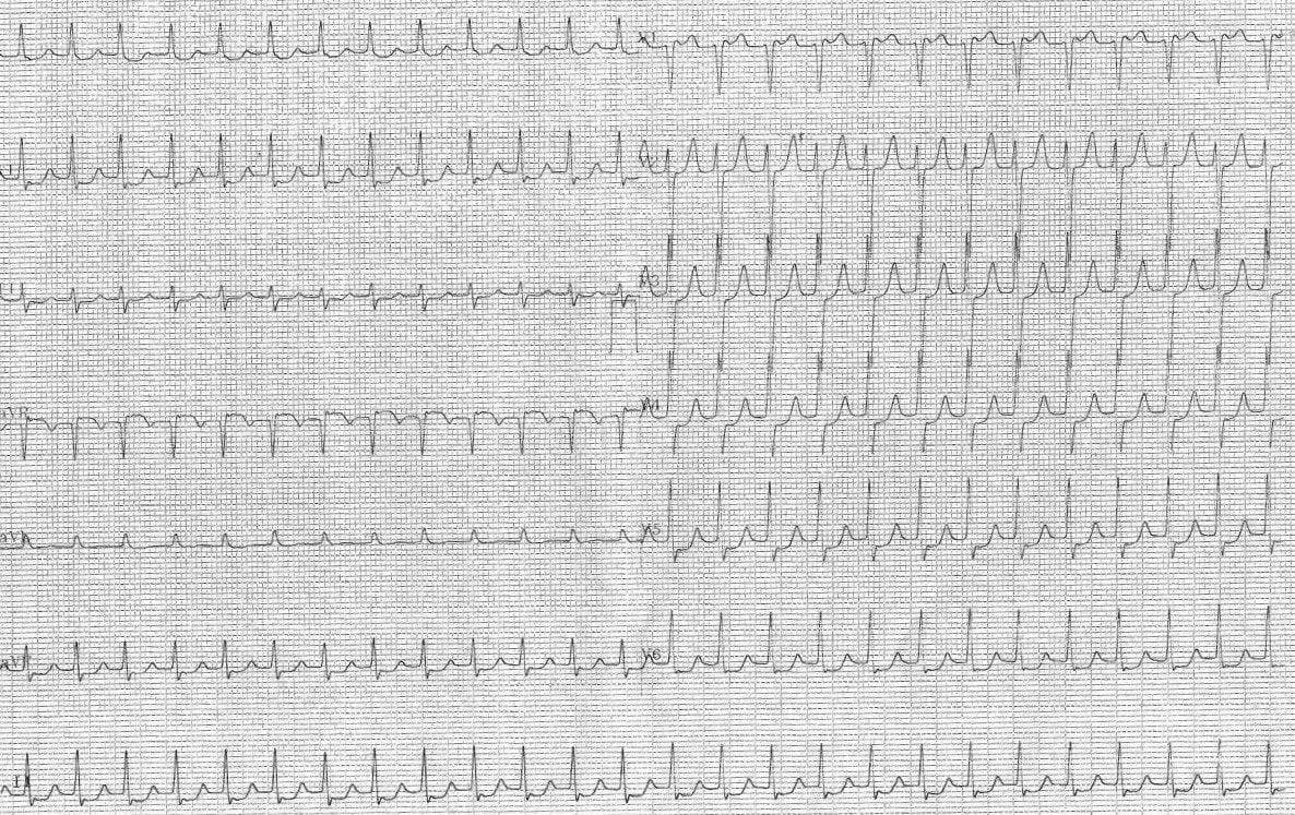 Mujer de 82 años HTA con antecedentes de ictus que presenta palpitaciones a nivel de cuello debidas a TRIN que cede con adenosina