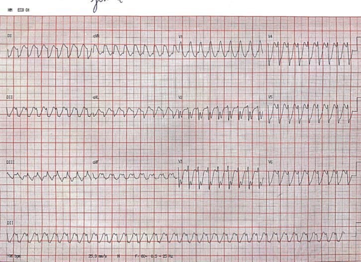 Paciente con antecedentes de palpitaciones, disnea y presíncope que se hallaba medicado con propafenona y ribaroxaban (que abandona unos días antes) debido a Aleteo Auricular 1:1 errónemante interpretado como TV y que requiere CVE