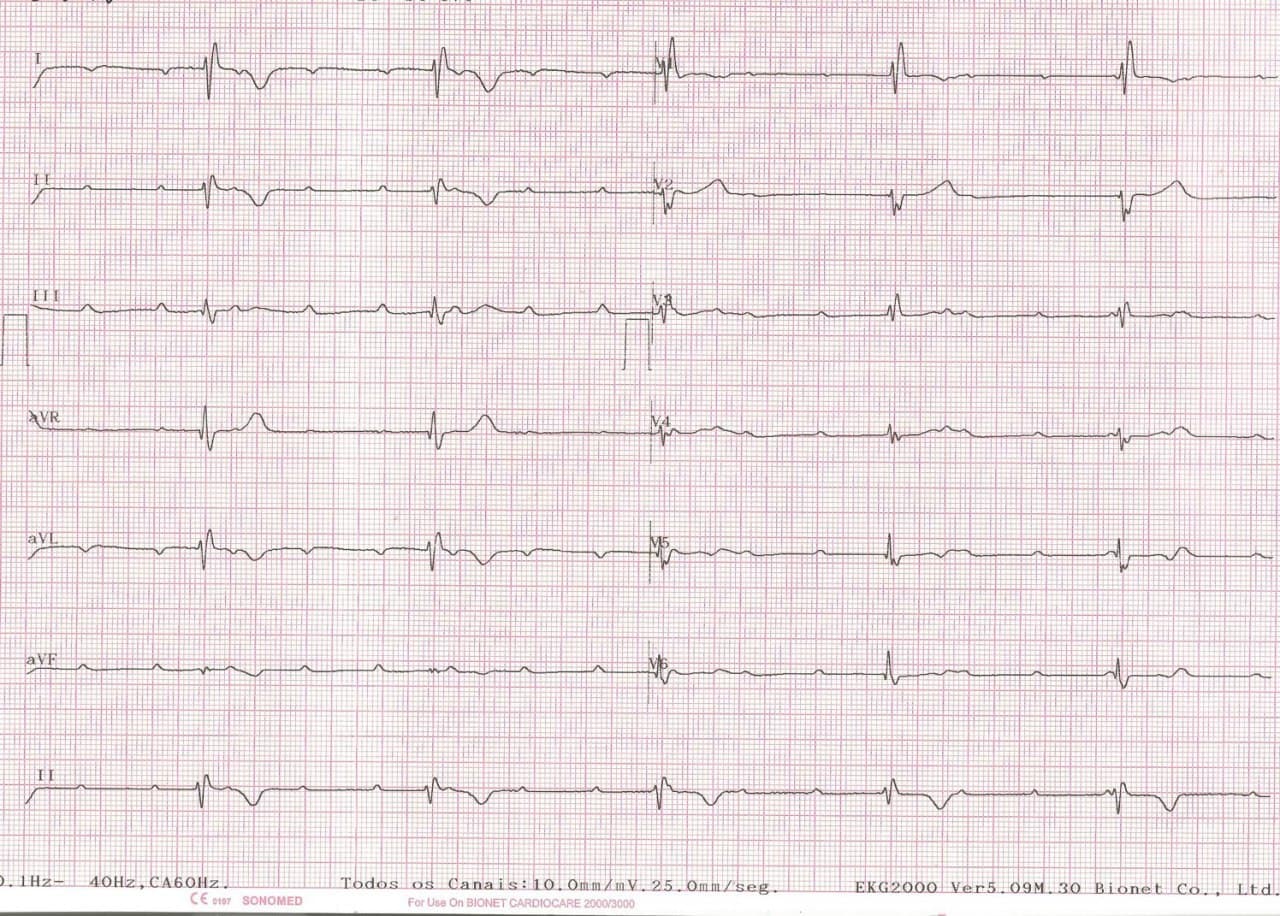 Mujer de 65 años com historia de síncope que presenta BAVC cuyo ECG tiene invertidos los electrodos de miembros superiores
