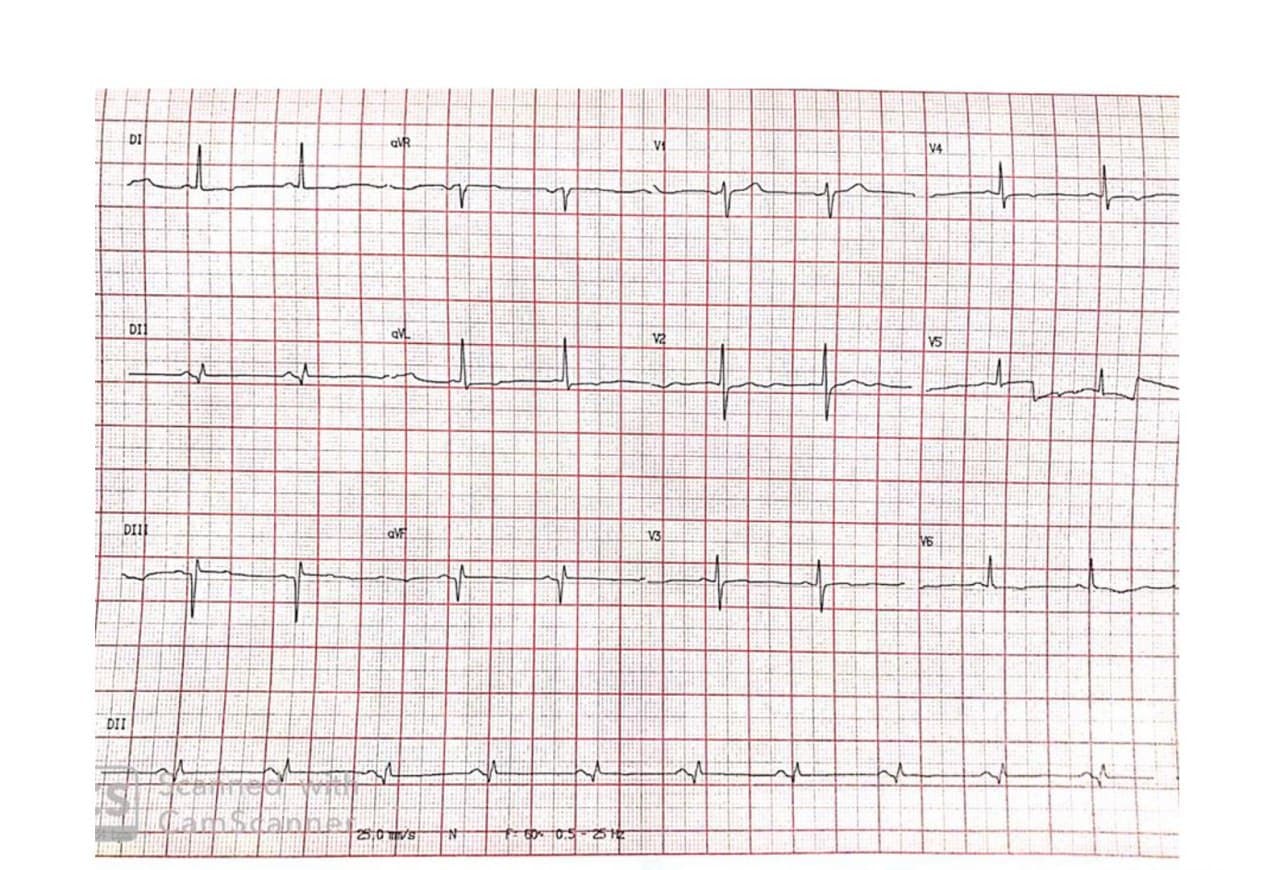 Mujer de 71 años con antecedentes de HTA, enfermedad coronaria revascularizada con ángor actual, hemangioma hepático, que presenta aneurisma con trombo + disección de la aorta proximal