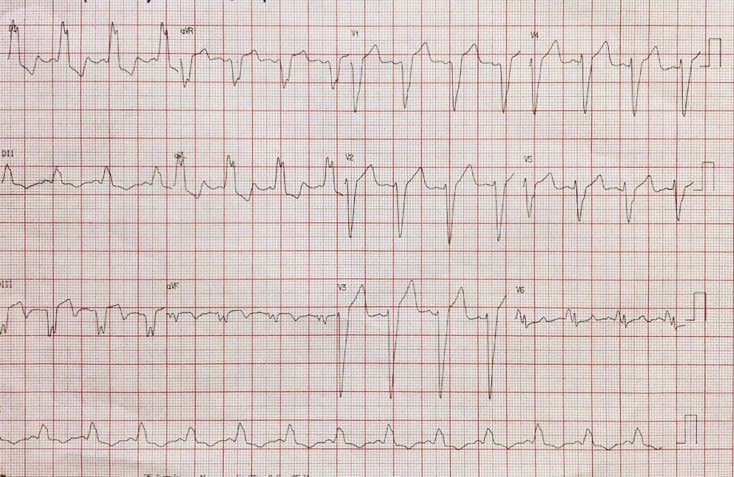 Hombre de 70 años con pico hipertensivo y disnea, que presenta necrosis ínferolateral y BCRI isquémico por compromiso de la Cx