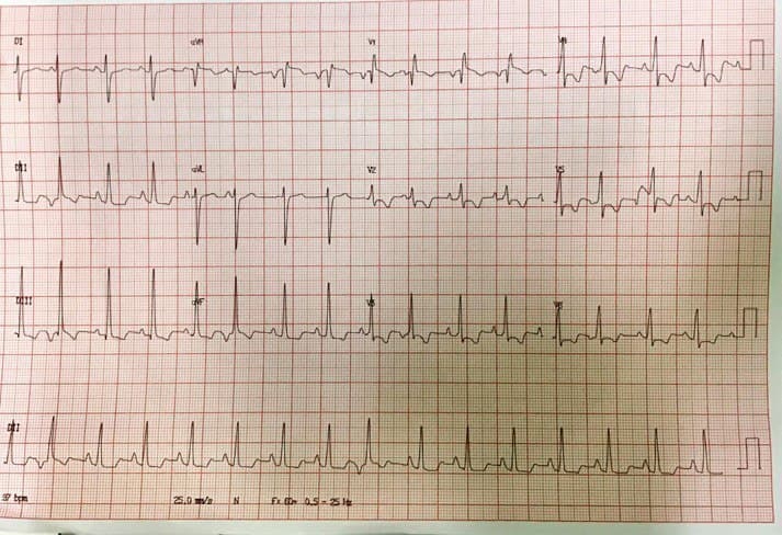 Mujer de 39 años con disnea progresiva y tos seca que presenta soplo sistólico en el foco pulmonar y segundo ruido hiperfónico sin desdoblamiento por CIA con cortocircuito significativo