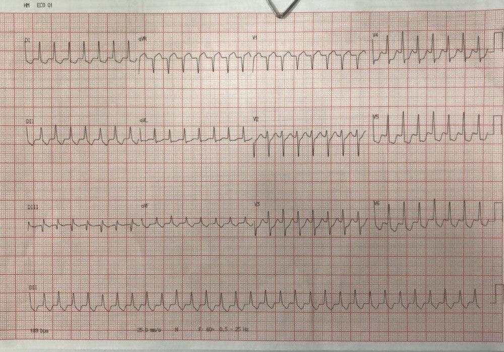 Mujer de 46 años con palpitaciones por TRIN que responde a adenosina, llamando la atención la depresión difusa del segmento ST en ausencia de enfermedad coronaria, atribuible a la propia taquicardia