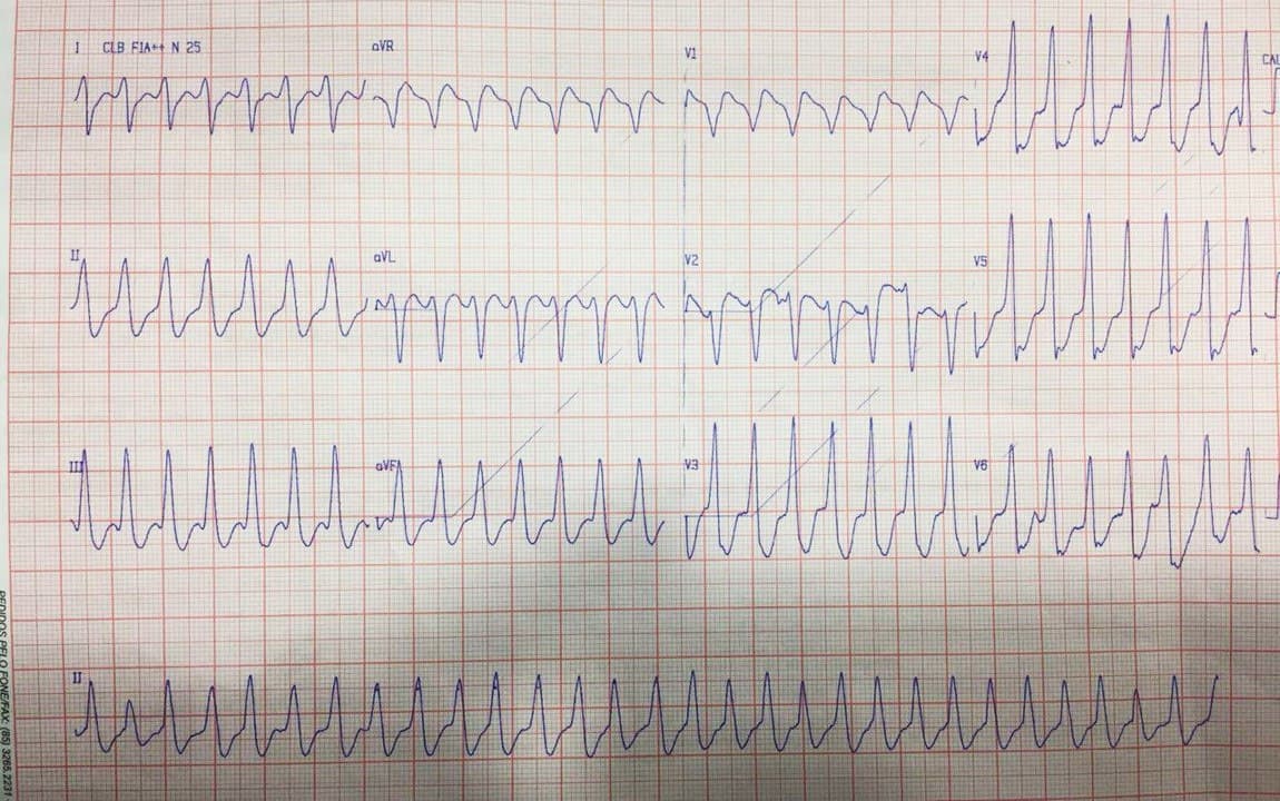 Paciente de 50 años con palpitaciones debidas a taquicardia ventricular originada en área de fibrosis mesocárdica post miocardítica