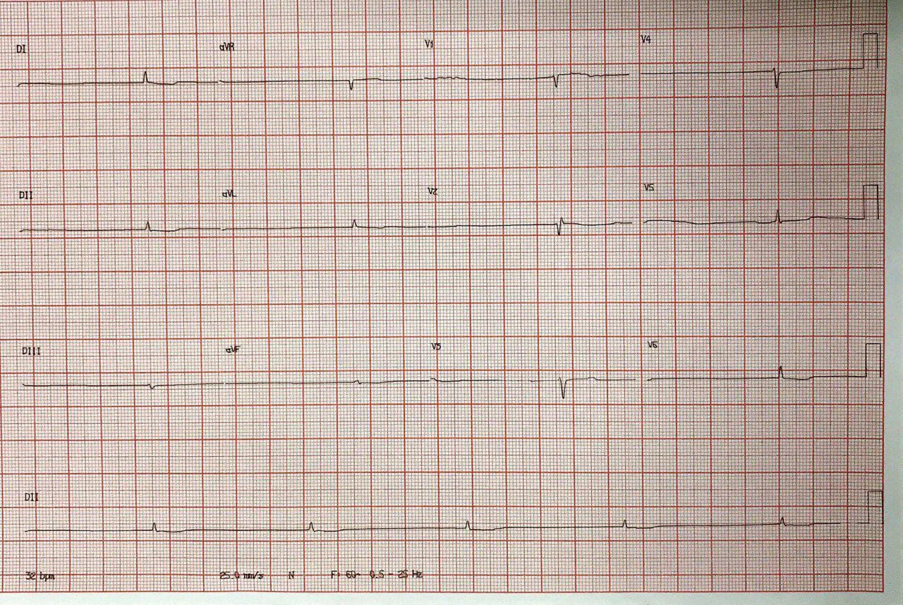 Mujer de 83 años con disnea, edemas en MMII y somnoliencia que presenta ECG con complejos de bajo voltaje con sospecha de hipotiroidismo, hiper K e intoxicación digitálica