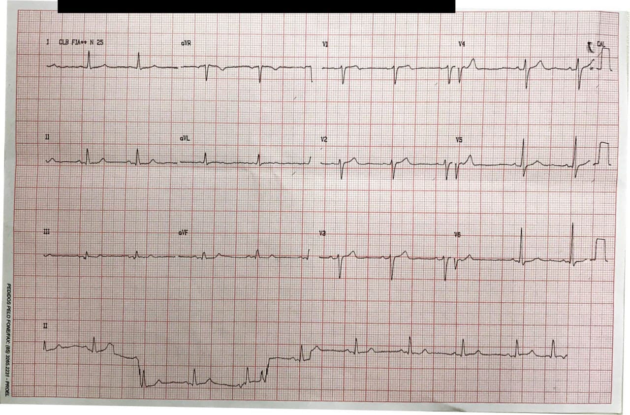 Hombre de 68 años con múltiples factores de riesgo que presenta ángor ante grandes esfuerzos por enfermedad coronaria con compromiso de DA y Cx y presencia de BIA-A