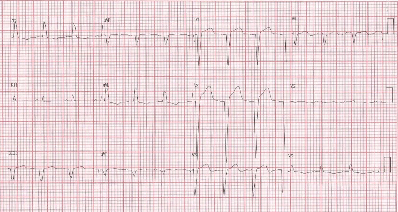 Mujer de 57 años con factores de riesgo que refiere mareos, tos y disnea y que presenta FV durante su translado en ambulancia siendo resucitada, con detección de hipocinecia difusa a predominio de cara inferior y troponina +
