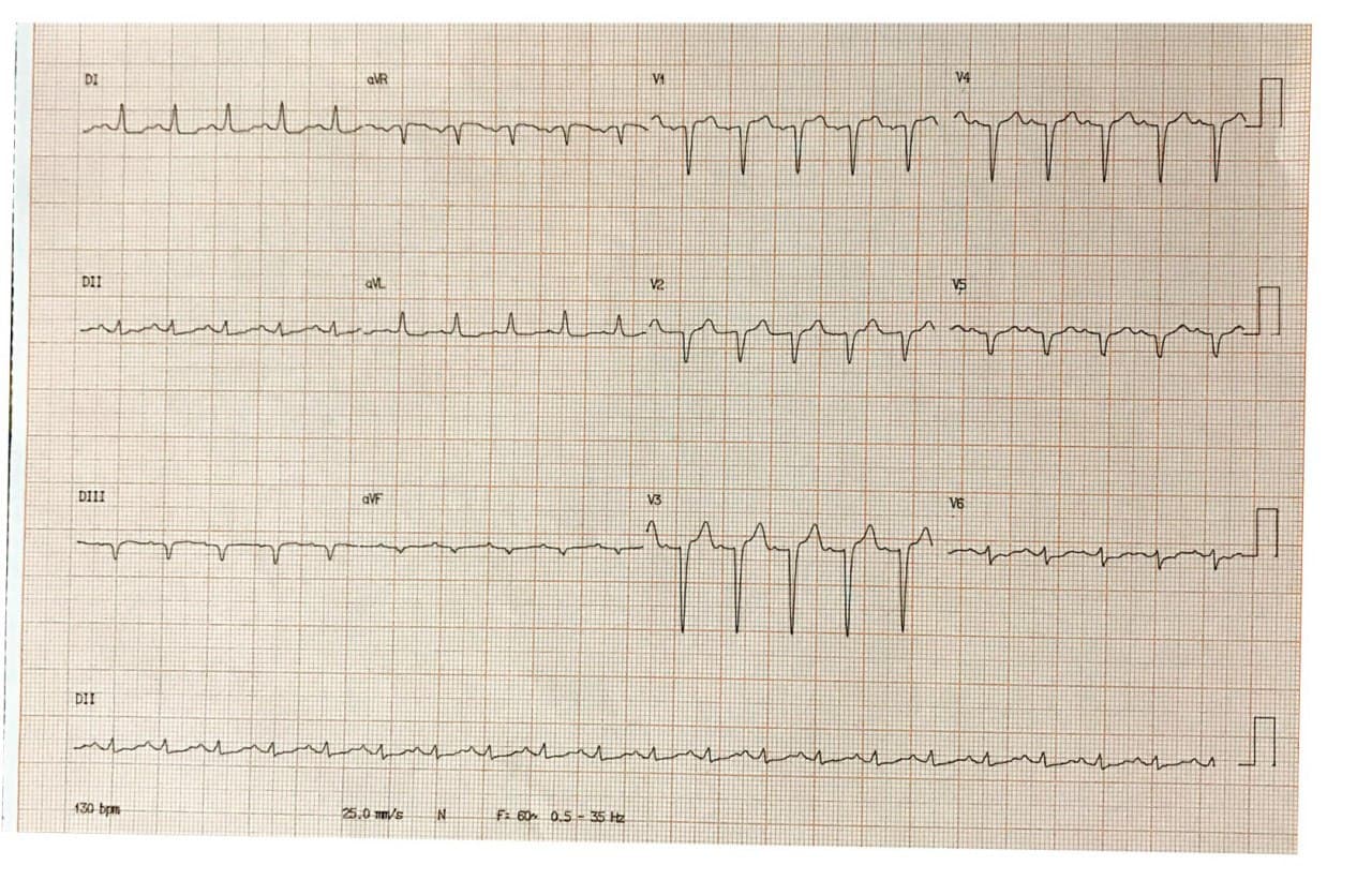 Mujer de 74 años con disnea progresiva y adinamia, con troponina + por TEP bilateral en contexto de presencia de trombos en AD y VD y  CA de riñón derecho