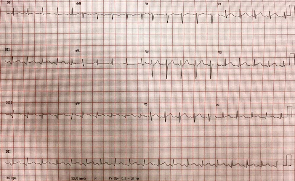 Paciente masculino de 44 años con intenso dolor precordial que desarrolla paro cardíaco por FV de la que es recuperado por presentar SCACEST por lesión con trombo de DA