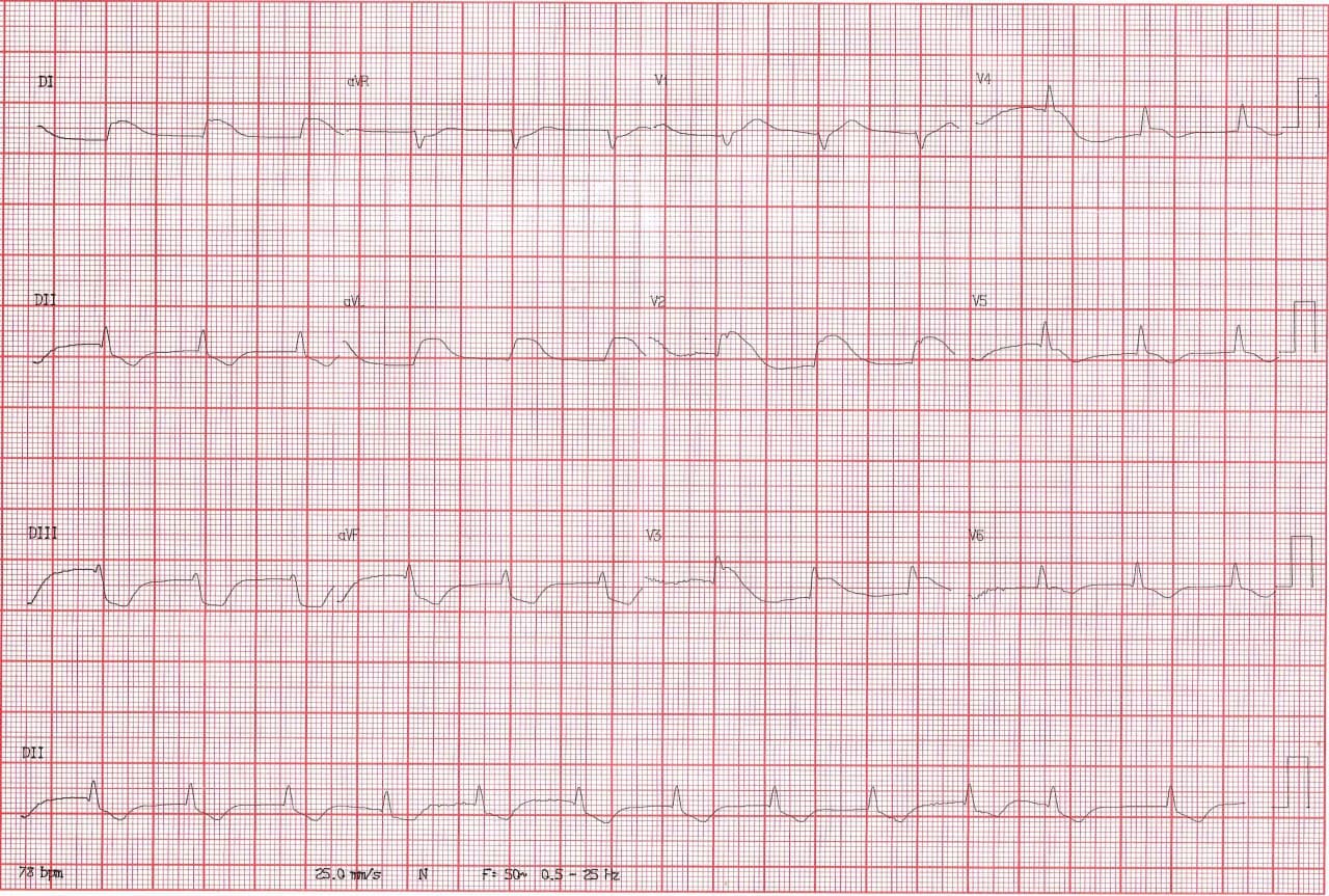 Hombre de 62 años con episodio de ángor y pérdida de consciencia, ingresando a Emergencias con FV que es revertida por compromiso de la DA proximal