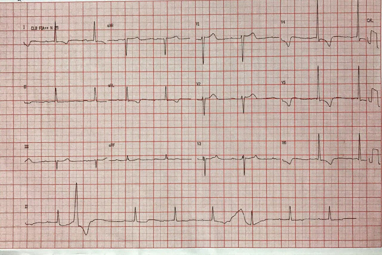 Hombre de 87 años con disnea progresiva y síncope por presencia de estenosis aórtica severa siendo sometido a TAVI