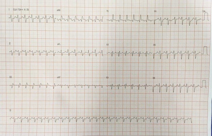 Mujer de 50 años DBT que refiere palpitaciones con presencia de TRIN que reponde a adenosina por presencia de vía anómala lateral izquierda