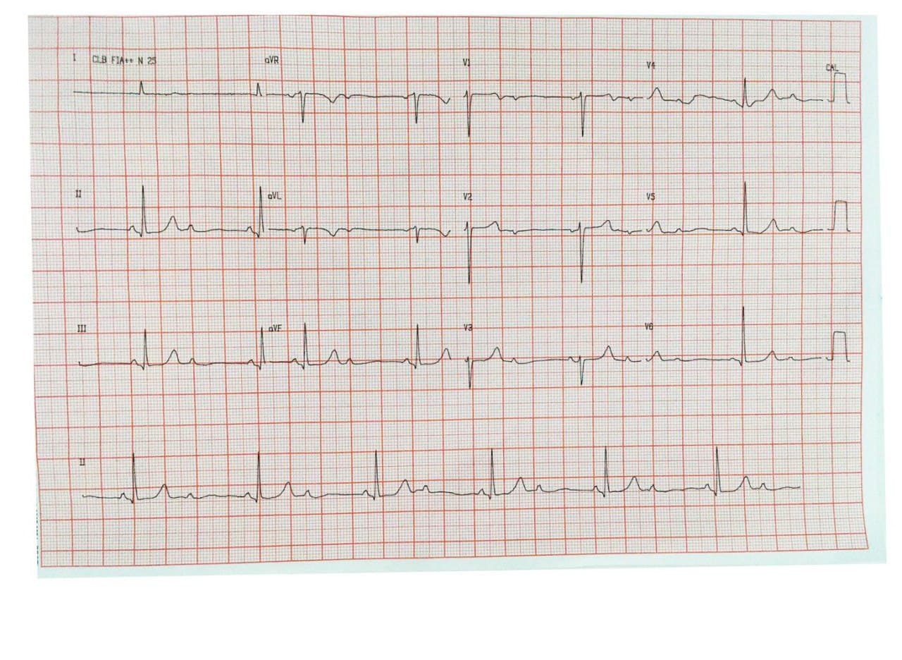 Mujer de 73 años que presenta BAV 2:1 con QRSs estrechos a quién erróneamente se suministra atropina desarrollando bloqueo BAV Mobitz II