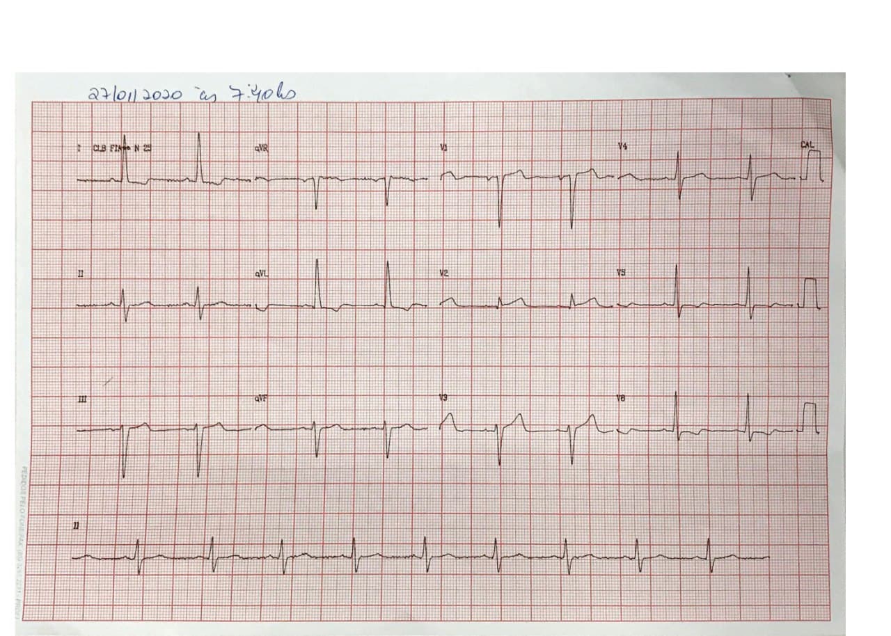 Hombre de 59 años HTA y DBT en IRC dialítica que presenta EAP y en quién se constata estenosis de arteria renal derecha