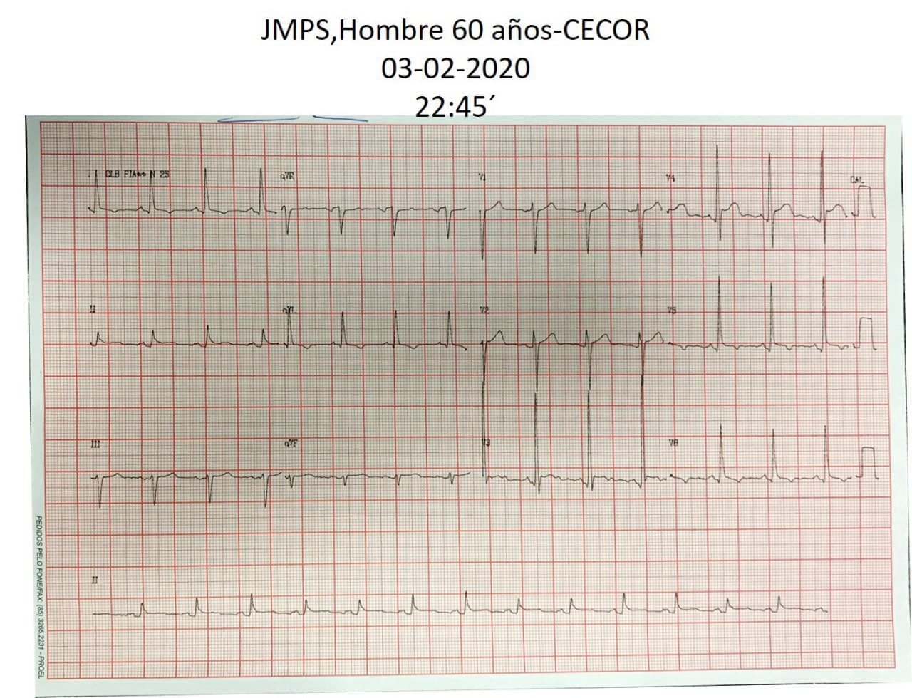 Hombre de 60 años hipertenso con intenso dolor retroesternal por disección aórtica tipo A
