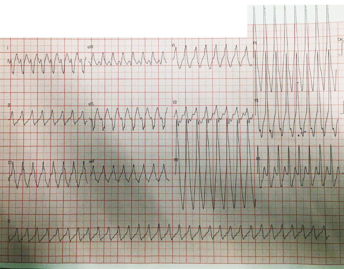Joven de 22 años con palpitaciones y disnea por presencia de TSV por vía accesoria pósterolateral