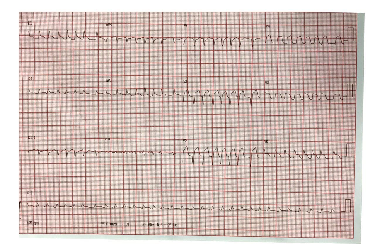 Mujer de 80 años con palpitaciones, mareos y sudoración que presenta FA con alta respuesta ventricular en contexto de IAMCEST por compromiso de la DA