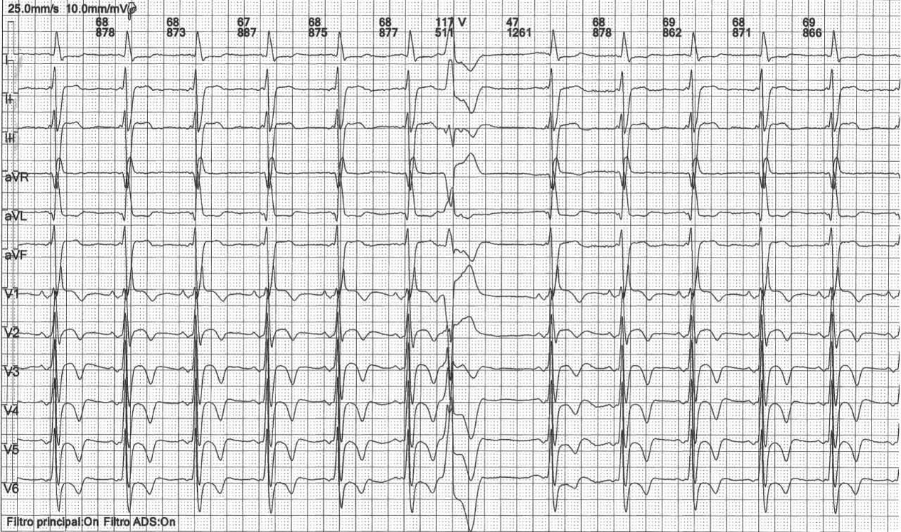 Hombre asintomático de 71 años con antecedente de ablación de aleteo auricular hace 7 años que presenta patrón ECG de WPW