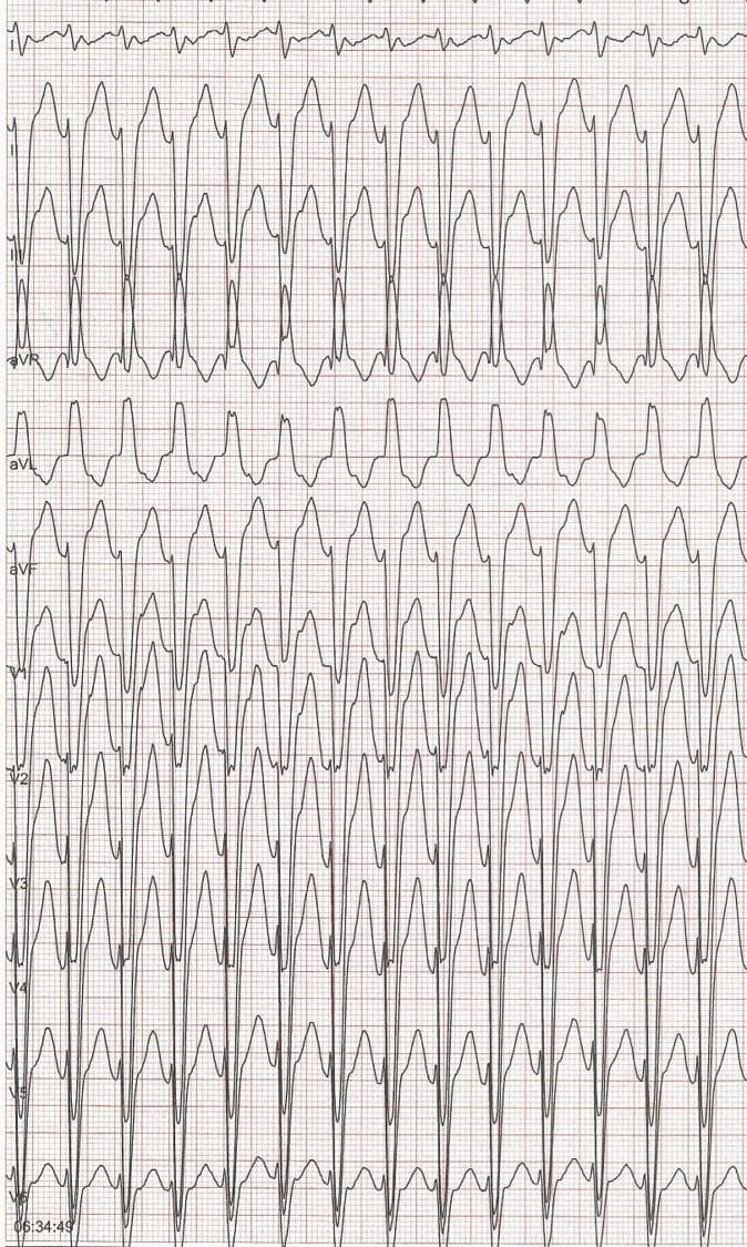 Mujer de 77 años, hipertensa y diabética con palpitaciones por presentar una TPSV que puede sospecharse por •  una onda ‘r’ inicial < de 30 ms •  un intervalo desde el comienzo de la onda R al pico de la S < 40 ms