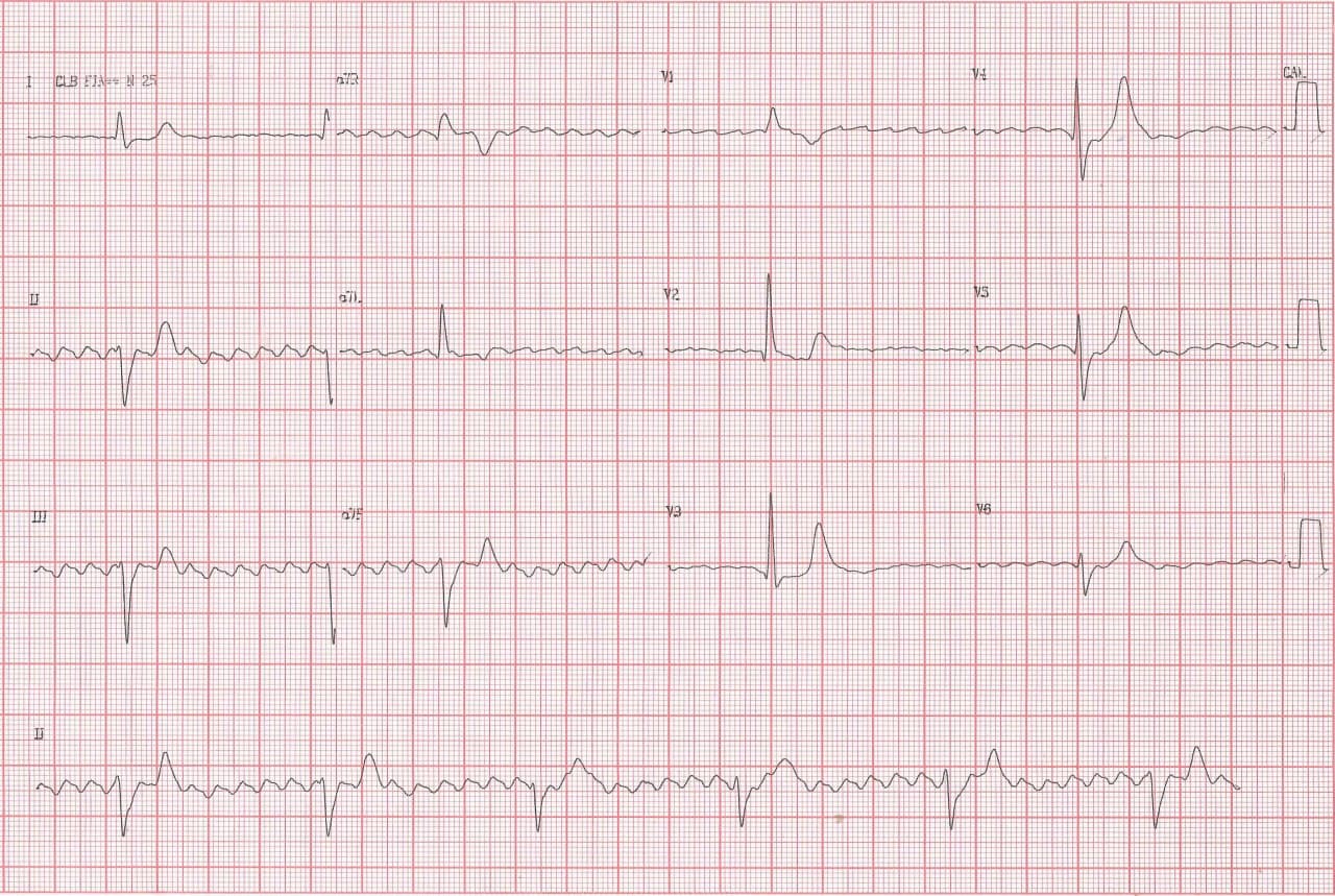 Hombre de 65 años con serología reactiva para Chagas que presenta episodios sincopales reiterados por presencia de aleteo auricular asociado a BAVC