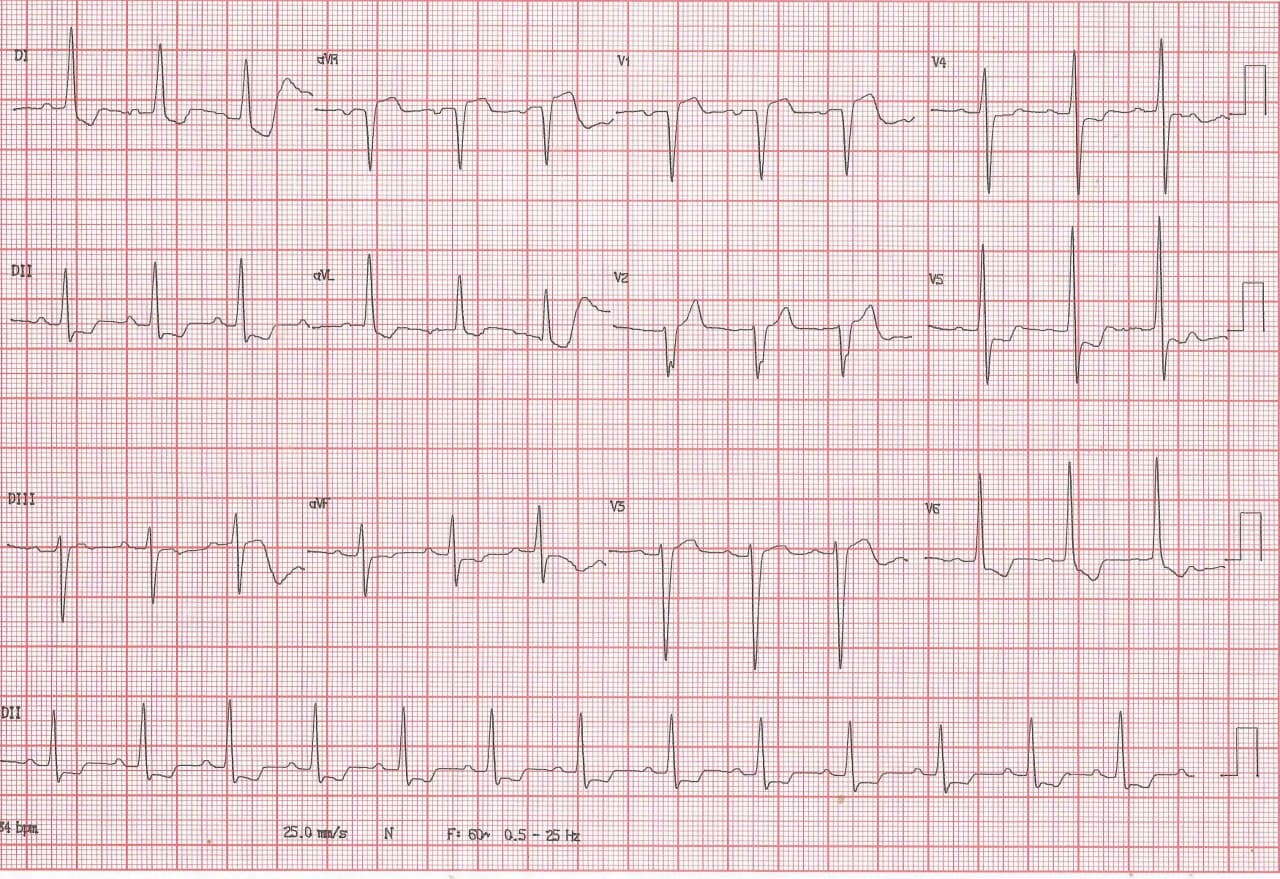 Mujer de 73 años, hipertensa no tratada que presenta epigastralgia con CCG normal por lo que los cambios en el ECG se interpretan como pseudo isquemia circunsferencial por HVI