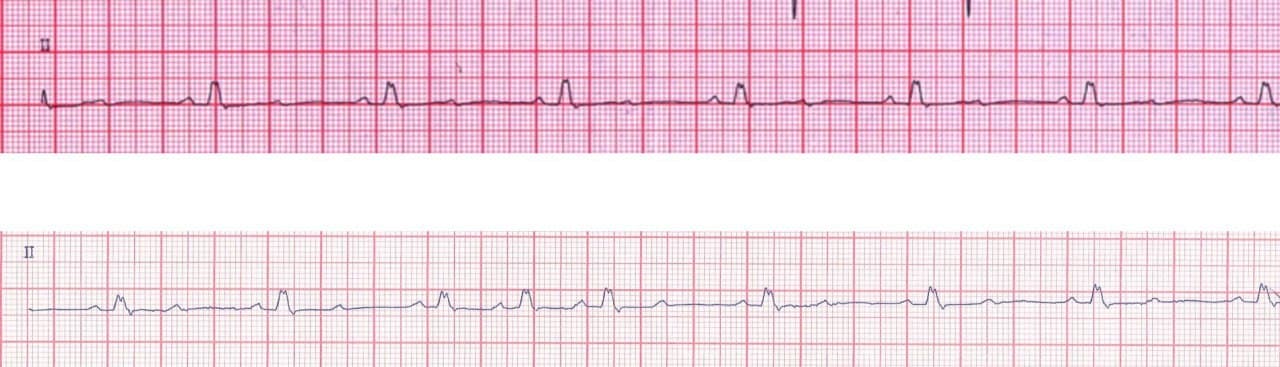Hombre de 81 años con historia de episodios sincopales que presenta BAV 2:1 asociado a BCRI