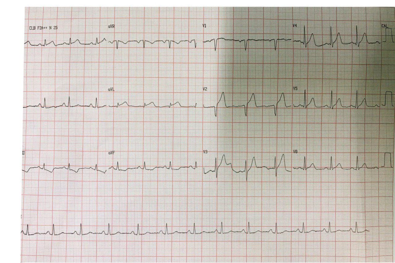 Hombre hipertenso de 59 años que presenta episodio de ángor prolongado con sobreelevación del segmento ST en DI y aVL sin depresión del segmento ST de V1-V2 a V3-V4 por compromiso de 1º diagonal