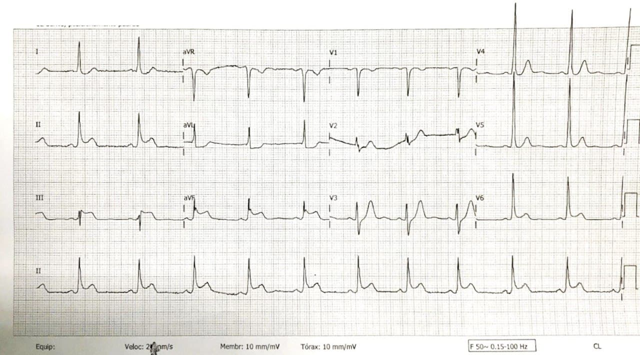Hombre de 65 años con múltiples factores de riesgo que presenta episodio de ángor prolongado debido a SCACEST por compromiso de Cx
