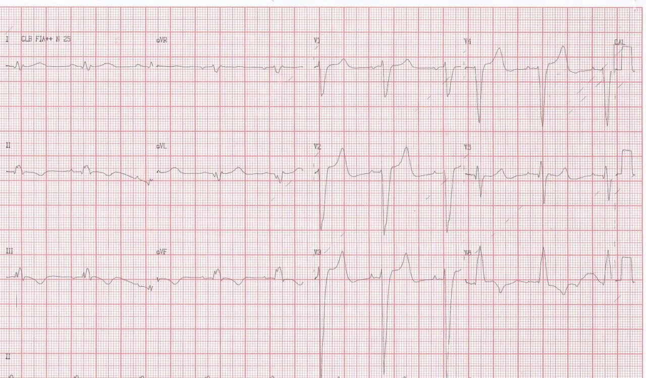 Paciente portador de miocardiopatía dilatada en insuficiencia cardíaca que presenta troponina positiva y CCG normal
