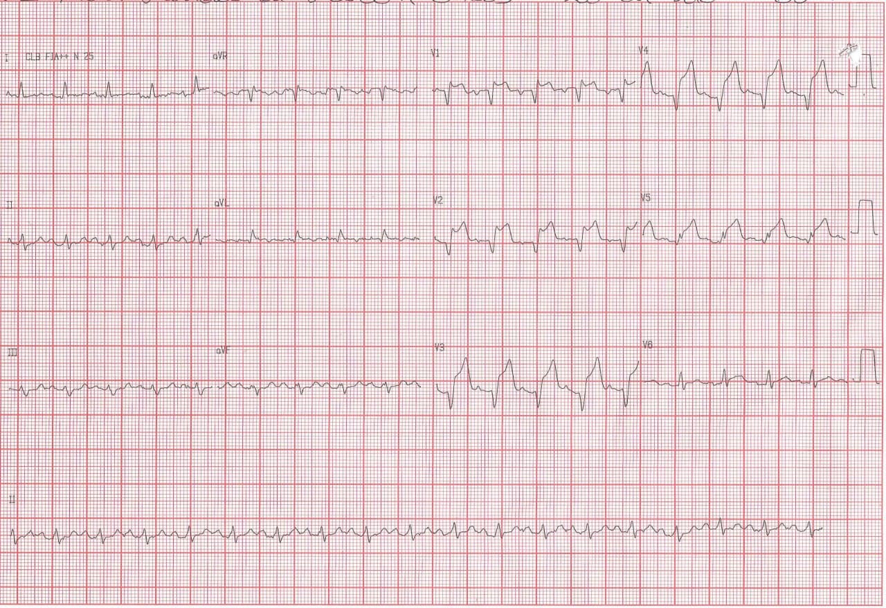 Paciente de 69 años con múltiples factores de riesgo que cursa SCACEST por compromiso de la DA con desarrollo ulterior de CIV muscular