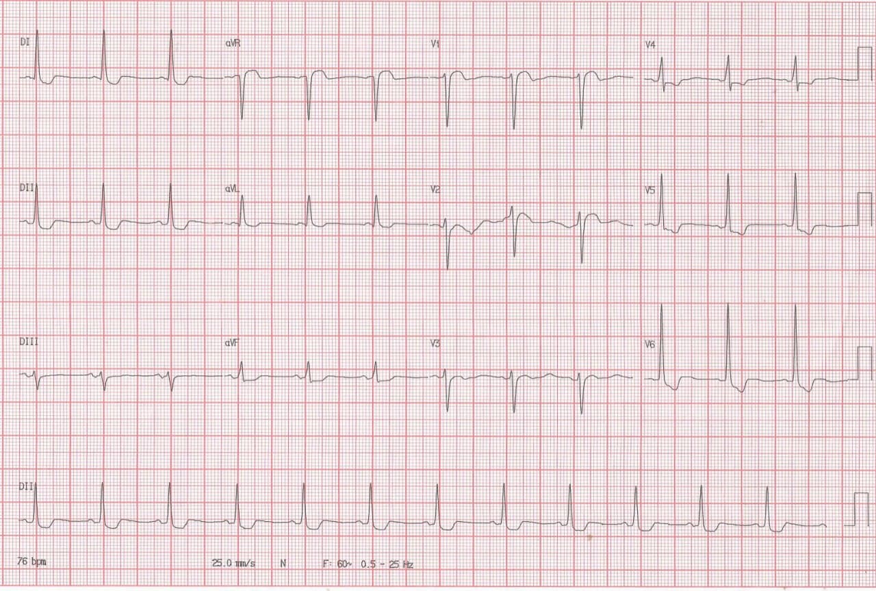 Mujer de 68 años con múltiples factores de riesgo, digitalizada crónicamente, que refiere ángor y disnea y que presenta HVI, signos de impregnación digitálica y presencia de aneurisma apical con trombo