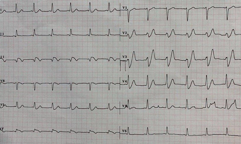 Paciente masculino de 48 años con antecedentes de IAMCEST de cara anterior con implante de stent farmacológico hace un mes y desarrollo de ángor prolongado no controlado por síndrome coronario agudo sin elevación del segmento ST (SCASEST) de cara inferior que mostró trombosis del stent en ADA (flujo TIMI 0) y evolución al óbito