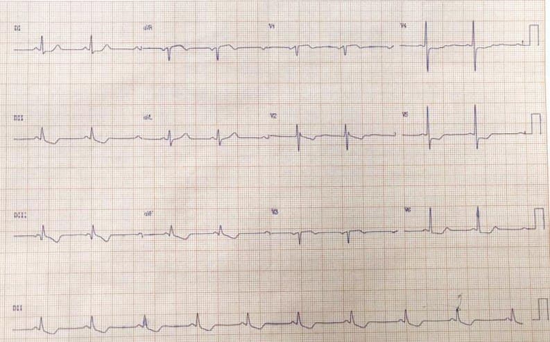Mujer de 44 años con factores de riesgo que presenta ángor de reciente comienzo ante esfuerzosy episodio de ángor de reposo actual por  enfermedad coronaria difusa con lesiones de DA, 1º diagonal, lesión aguda de Cx, marginal, CD y descendente posterior