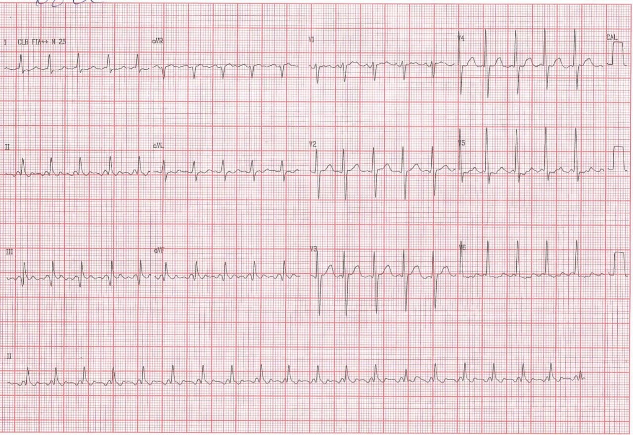 Paciente masculino de 68 años con múltiples factores de riesgo y antecedentes de episodios de disnea paroxística que presenta aleteo auricular 2:1 y severas lesiones coronarias