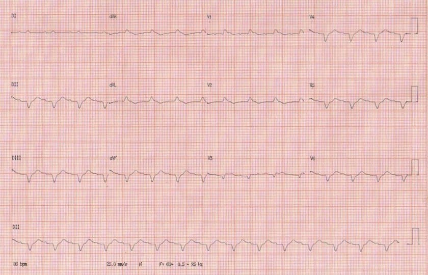 Mujer de 48 años con cuadro viral agudo hace 15 días cursando con náuseas, vómitos, somnolencia e hipotensión que presenta signos de miopericarditis constatándose hipocinesia difusa y baja Fey con necrosis miocítica difusa y marcada en la biopsia endomiocárdica