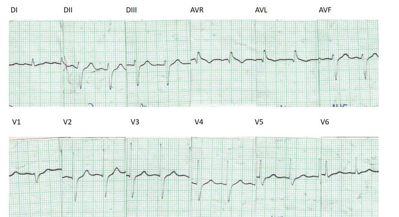 Evolución electrocardiográfica entre 1990 y 2007 de mujer portadora de enfermedad de Chagas determinando BDAM que se agrega al HbAI preexistente